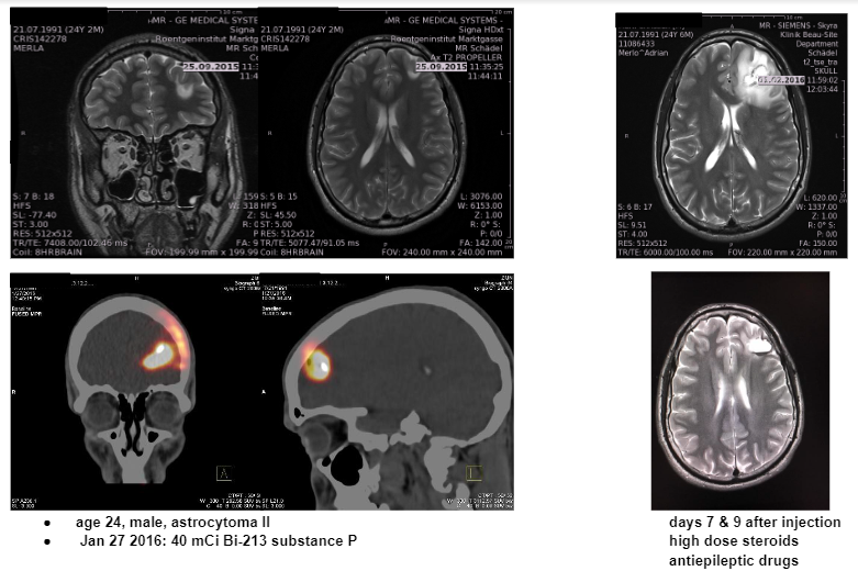 Glioma