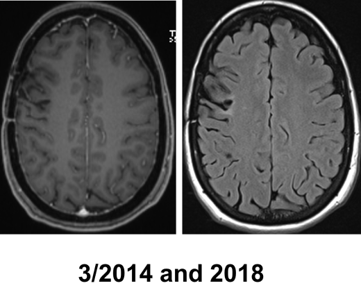 Glioma